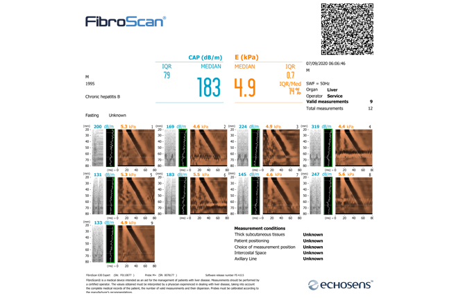 Giá máy Fibroscan