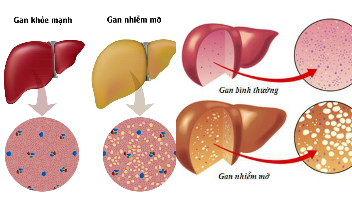 Các chỉ định cần đo FibroScan