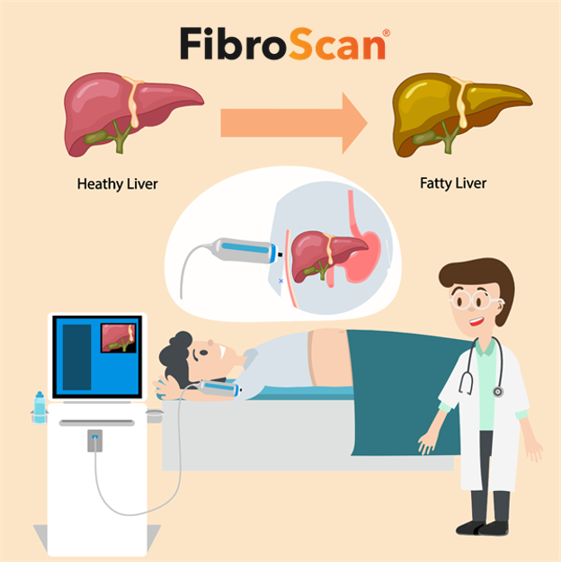 FibroScan-ky-thuat-khong-xam-lan-chuyen-biet-cho-gan