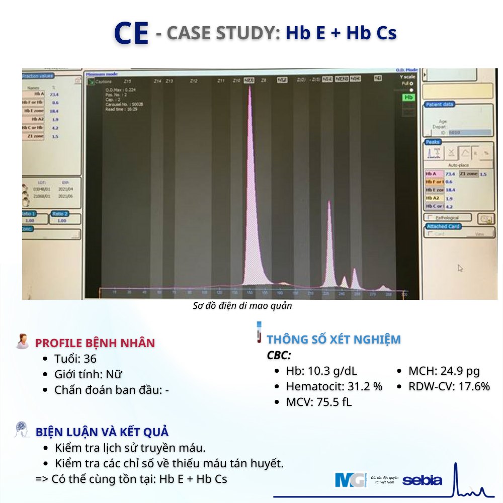 CE-Case-study-HbE-HbCs-dien-di-mao-quan-sebia-Capillary-Electropherosis-