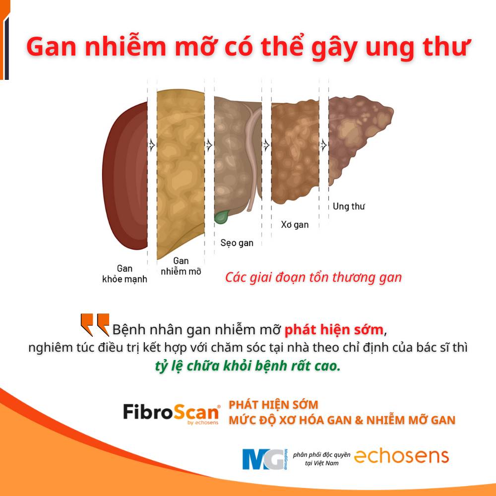 gan-nhiem-mo-co-the-gay-ung-thu-fibroscan-medigroup-vietnam